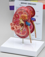 Diseased Kidney Pharmaceutical and Anatomical Model Gifts